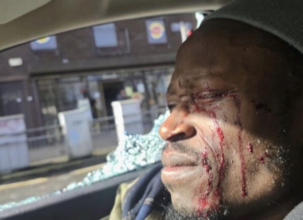 Nigerian Dancer Tobi Omoteso in Ireland Loses Vision After Brutal Road Rage Attack